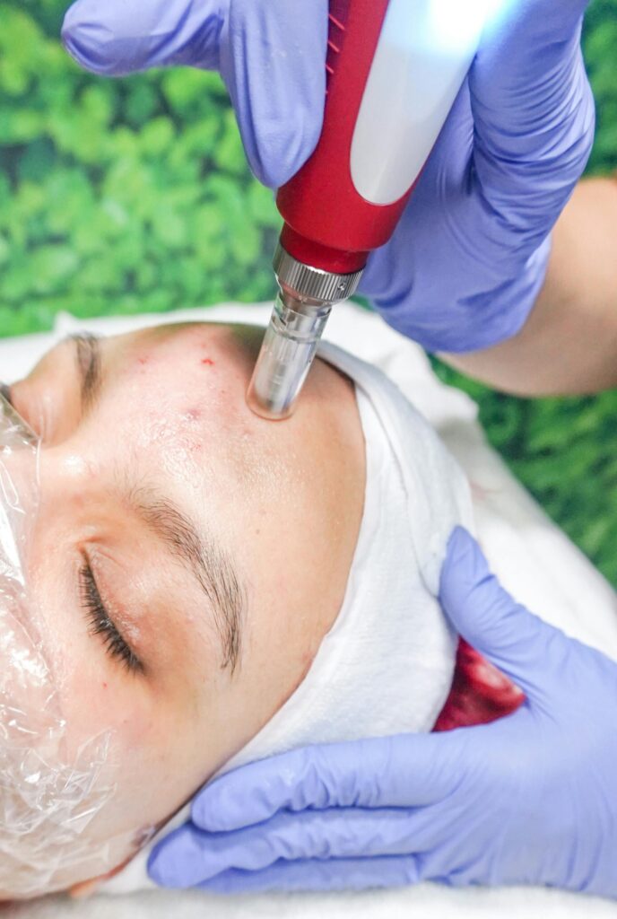 Tratamiento con dermapen en la fente a una mujer